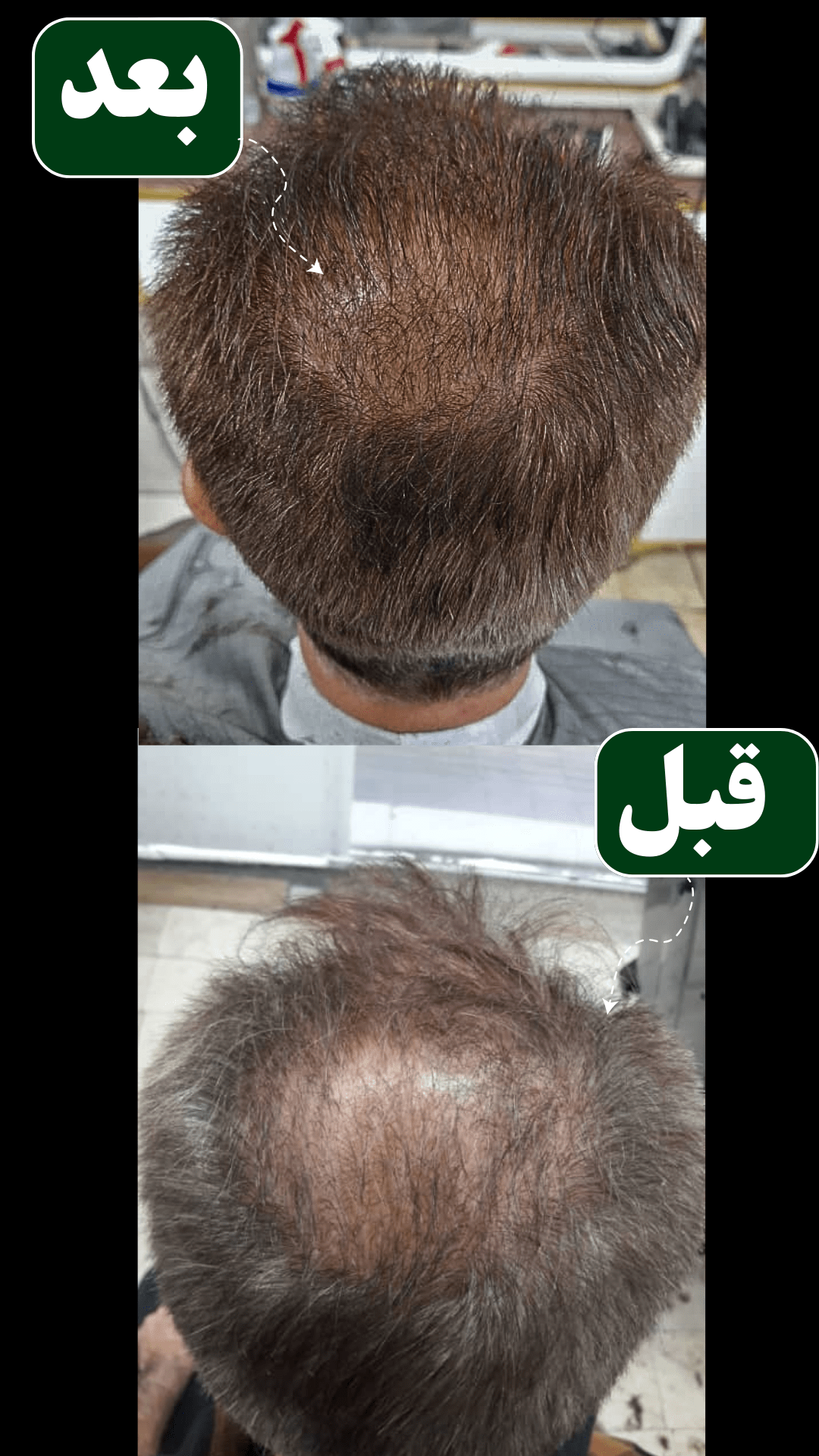 قبل و بعد استفاده پک شامپو اکسنتیدو