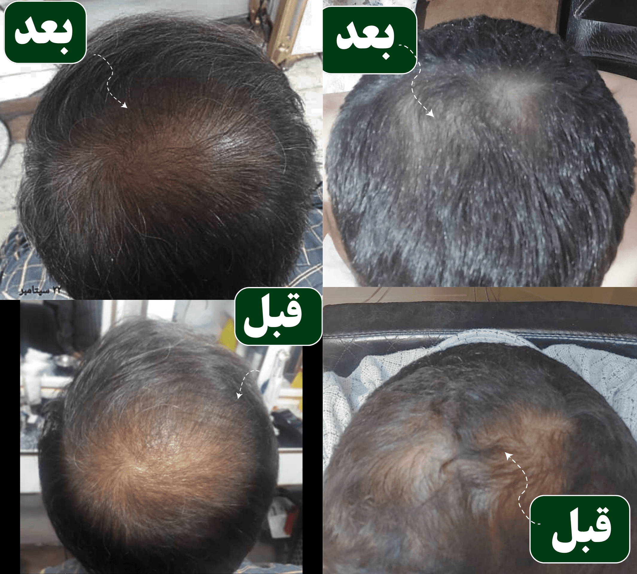 قبل و بعد استفاده از شامپو اکسنتیدو